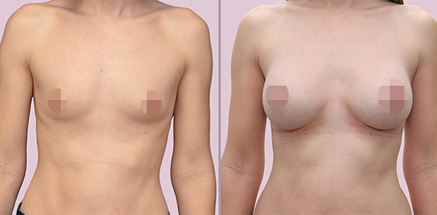 Breast augmentation before and after age 34, 34A to 34C, 5'8 125 lbs by Ditesheim Cosmetic Surgery Charlotte NC