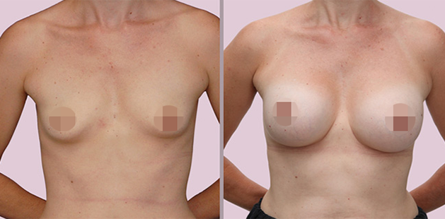 Breast augmentation before and after, age 31, 5'0" 118 lbs, 34A to 34C at Ditesheim Cosmetic Surgery, Charlotte