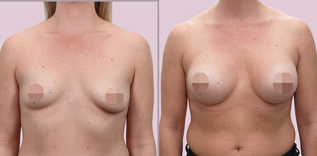 Ditesheim Cosmetic Surgery breast augmentation before and after highlighting enhanced volume.