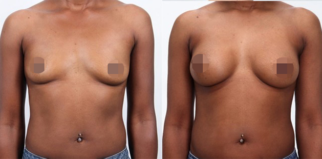 Breast enhancement results with smooth, proportional contour after augmentation.