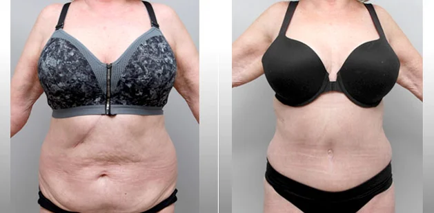 Plastic surgery before and after results showing full-body contouring for moms.