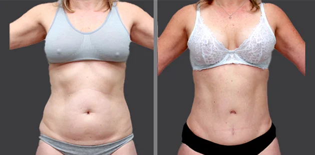 Abdominoplasty and breast enhancement before and after transformation.