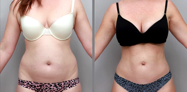 Mommy makeover showing restored body shape and tighter abdomen.