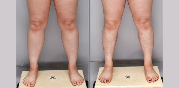 Lipedema surgery before and after at Ditesheim Cosmetic Surgery Charlotte