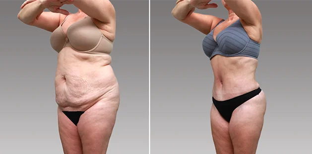 Mommy makeover before and after transformations showing flatter abdomen and improved curves.