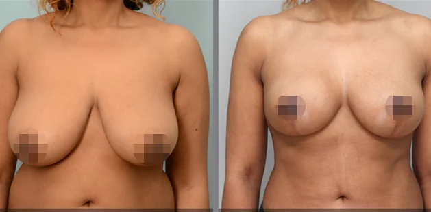 Plastic surgery before and after results showing full-body contouring for moms.