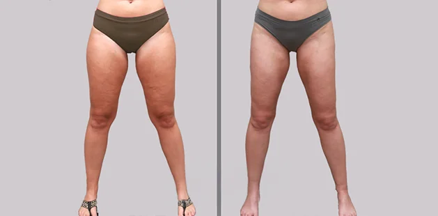 Before and after lipedema reduction treatment showing smoother thighs and balanced leg shape