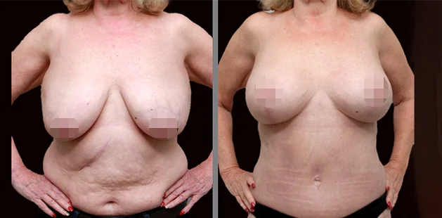 Before and after mommy makeover results showing flatter midsection and enhanced breast contour.