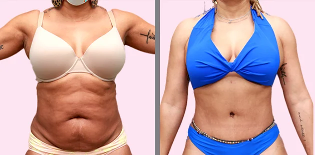 Mommy makeover showing restored body shape and tighter abdomen.