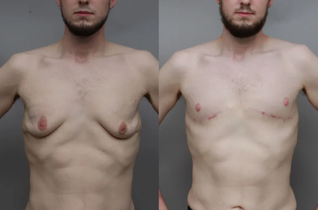 Before and after male body contouring showing refined torso shape and improved upper body balance | Gynecomastia treatment results at Ditesheim Cosmetic Surgery Charlotte