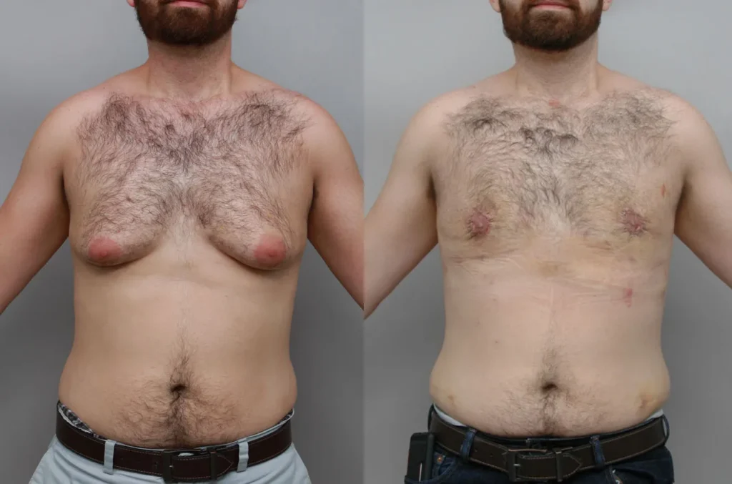 Before and after gynecomastia correction highlighting chest symmetry and smoother contour | Male cosmetic surgery results at Ditesheim Cosmetic Surgery Charlotte