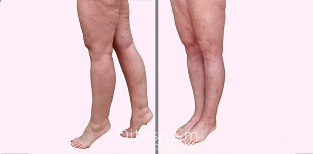 legs side (1)