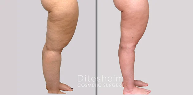 legs side (2)