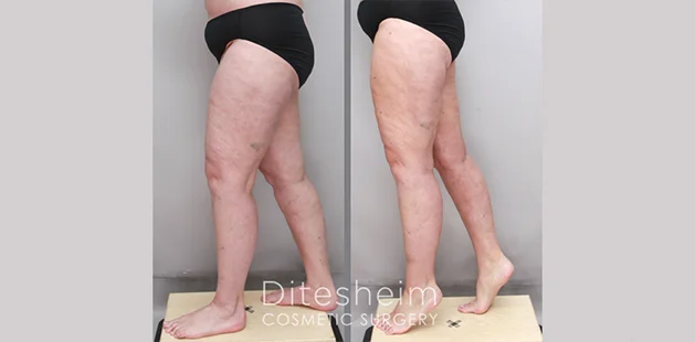 legs side