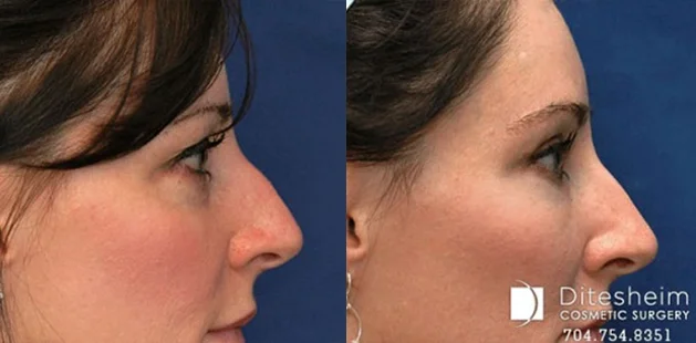 Facial plastic surgery results at Ditesheim Cosmetic Surgery Charlotte