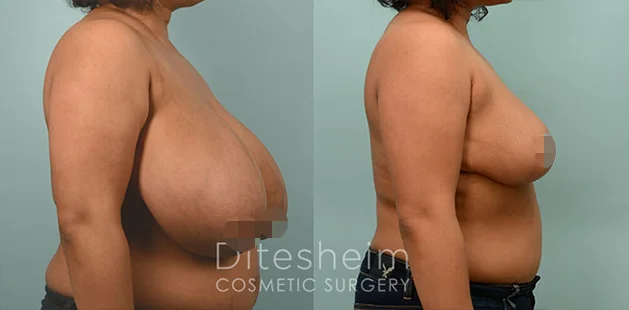 Patient before and after breast reduction demonstrating lifted, natural-looking results.