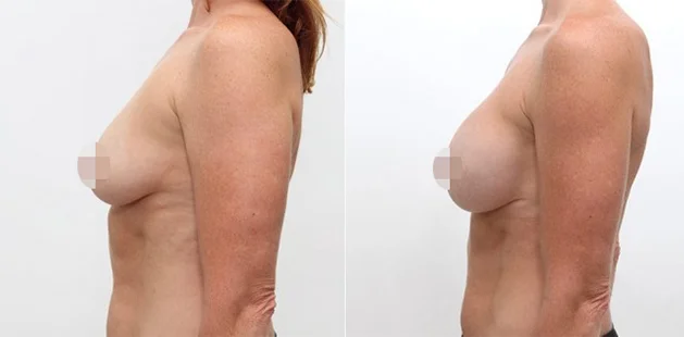 Breast implant results showing restored fullness and youthful contour at Ditesheim Cosmetic Surgery.
