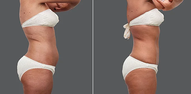Post-weight loss body lift and contouring before and after results at Ditesheim Cosmetic Surgery.
