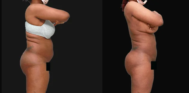 Full-body view before and after buttock lift and augmentation results.