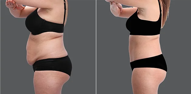 Comprehensive mommy makeover showing improved waistline and lifted bust.