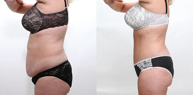 Before and after mommy makeover showing flatter abdomen and lifted breasts at Ditesheim Cosmetic Surgery.
