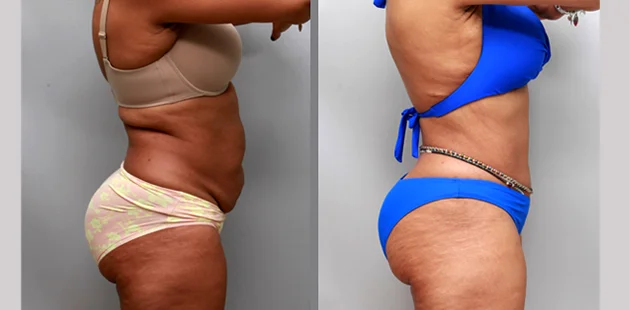 Comprehensive mommy makeover showing improved waistline and lifted bust.