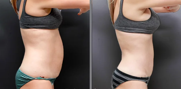 Before and after body contouring and breast enhancement after pregnancy.