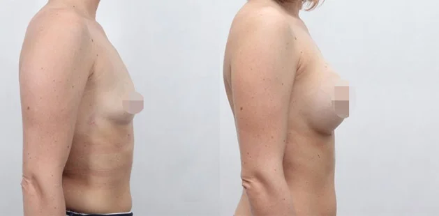 Natural-looking breast augmentation before and after transformation at Ditesheim Cosmetic Surgery.