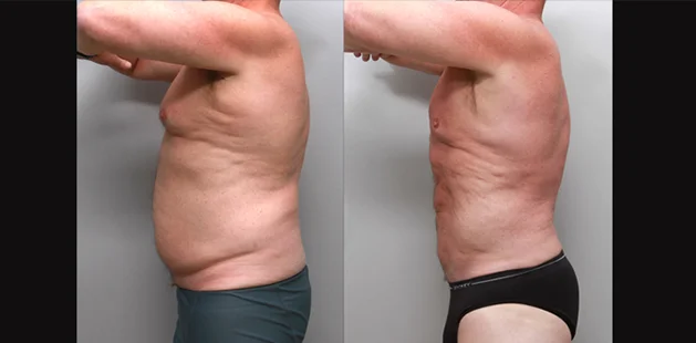 Side view of male liposuction results showing reduced fat and improved back contour.
