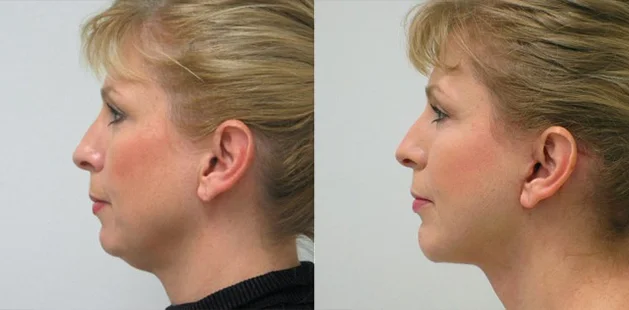 Before and after facelift profile view showing improved neck contour, defined jawline, and smoother lower face – Ditesheim Cosmetic Surgery Charlotte NC.
