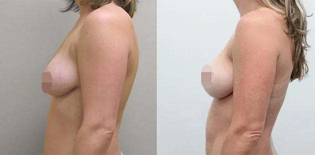 Before and after photo showing improved breast position and smooth contour after lift.