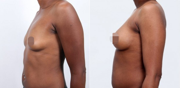 Profile view of breast augmentation results with improved projection and firmness.