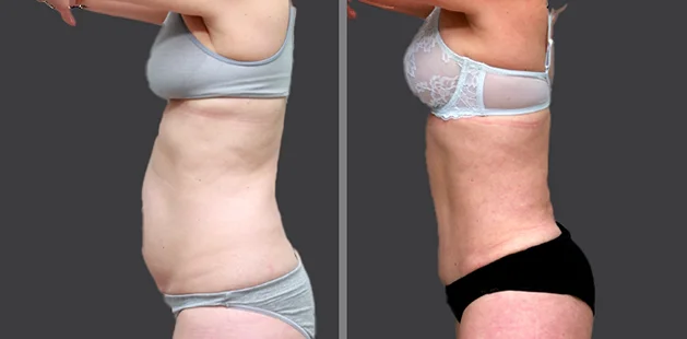 Before and after body contouring and breast enhancement after pregnancy.