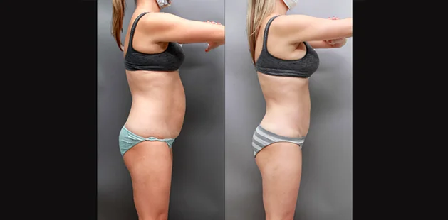 Before and after body contouring and breast enhancement after pregnancy, side view.