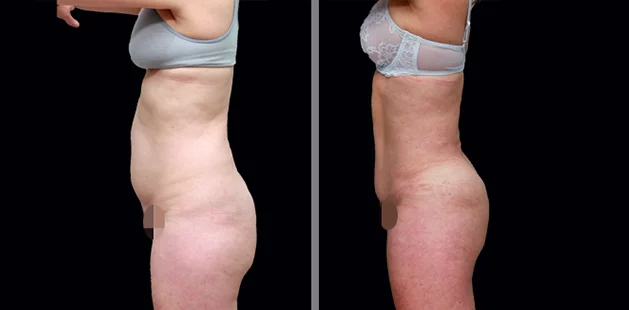 Before and after body contouring and breast enhancement after pregnancy.