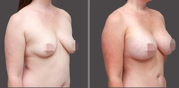 Breast lift and tummy tuck before and after results for post-pregnancy transformation.
