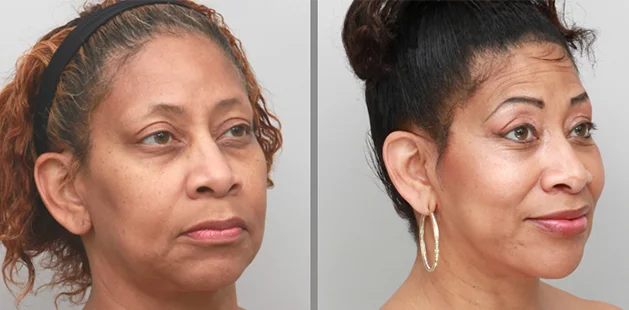 Before and after facelift and eyelid surgery showing refreshed, more youthful facial balance