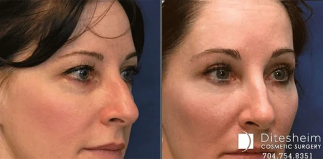 Before and after eyelid lift demonstrating brighter eyes and refreshed upper face appearance