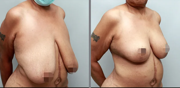 Before and after breast reduction showing lifted, smaller breasts with improved contour at Ditesheim Cosmetic Surgery.