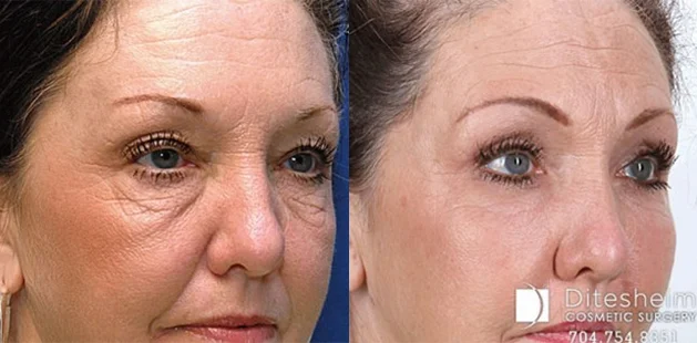 Before and after facelift showing smoother skin and lifted facial contours | Facial rejuvenation results at Ditesheim Cosmetic Surgery Charlotte