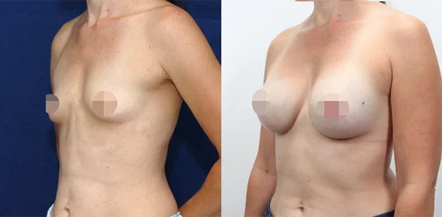 Patient before and after breast enhancement with natural, balanced results.
