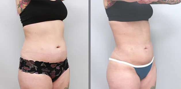 Mommy makeover before and after transformations showing flatter abdomen and improved curves.