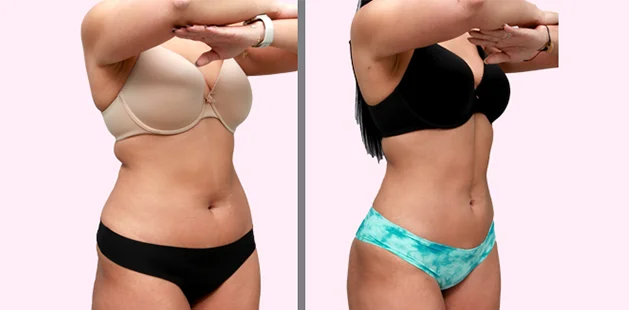 Patient before and after images showing smoother contours and improved body tone.