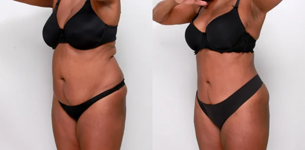 Liposuction and tummy tuck before and after results for enhanced body definition at Ditesheim Cosmetic Surgery.