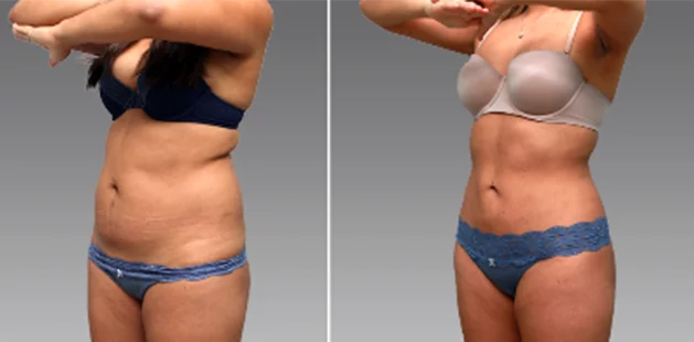 Patient before and after images showing smoother contours and improved body tone.