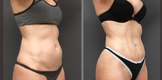 Liposuction and tummy tuck before and after results for enhanced body definition, side angle view.