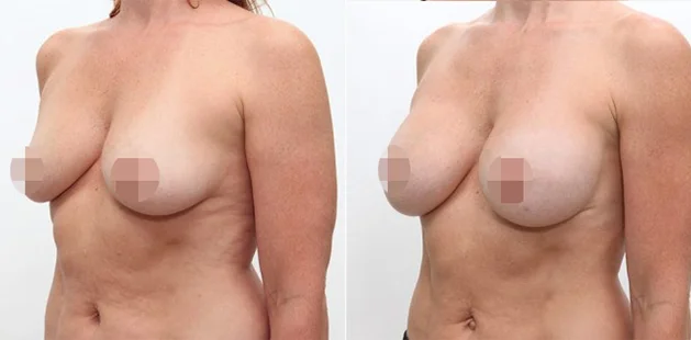Breast implant enhancement with improved shape and projection before and after.
