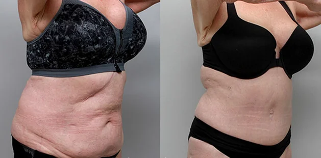 Before and after mommy makeover showing flatter abdomen and lifted breasts at Ditesheim Cosmetic Surgery.