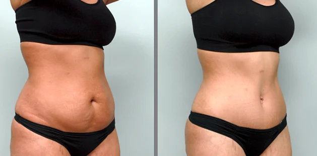 Mommy makeover showing restored body shape and tighter abdomen.