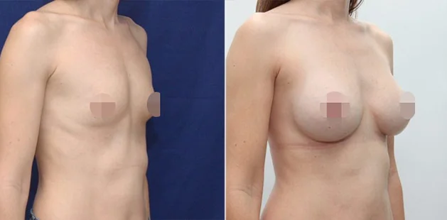 Profile view of breast augmentation results with improved projection and firmness.